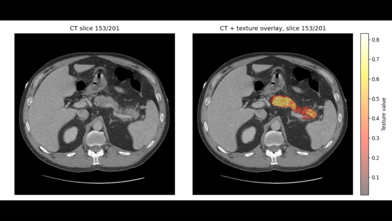 Ilmuwan Kembangkan AI yang Bisa Mendeteksi Kanker Pankreas Sebelum Tumor Terlihat